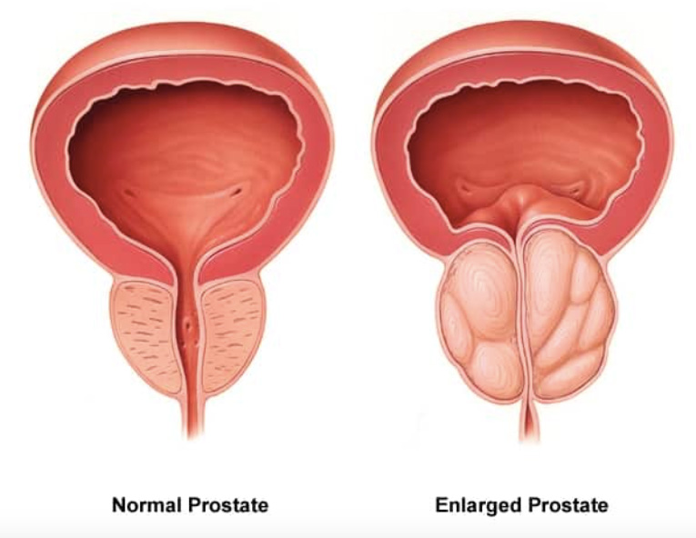 Prostrate Enlargement Treatment